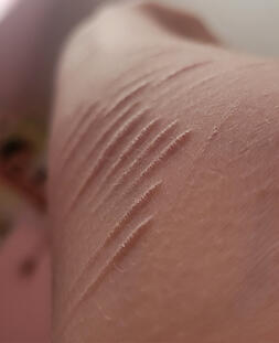 scars
